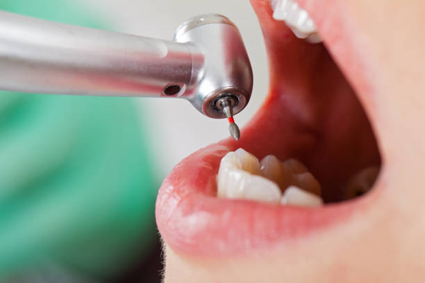 Best Emergency Treatment for Dental Infections or Abscesses in Richfield, UT